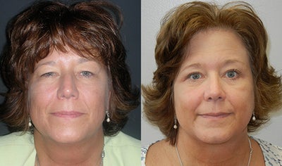Eyelid Surgery before and after photo