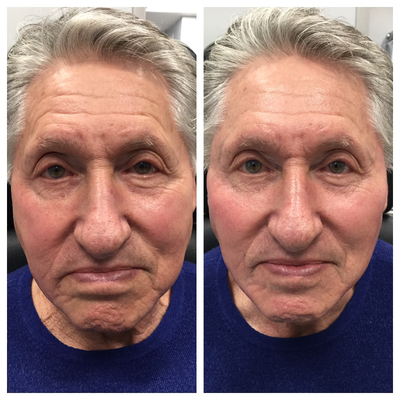Skin Rejuvenation before and after photo
