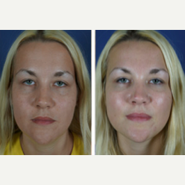 Cheek Augmentation before and after photo