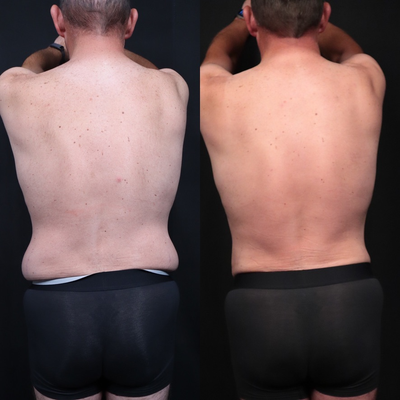 BodyTite before and after photo