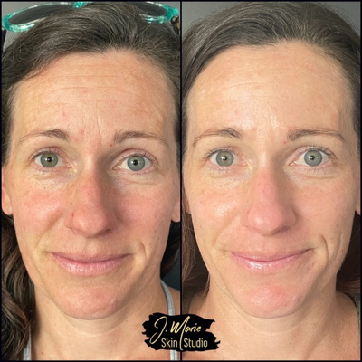 Juvederm before and after photo