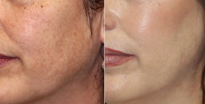 IPL before and after photo