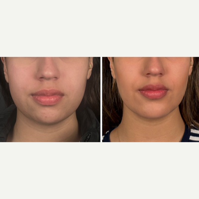 Chin Implant before and after photo