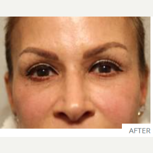 Do Brow Lifts Look Natural?: Robert M. Schwarcz, MD : Cosmetic Surgery