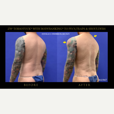 Body Lift before and after photo