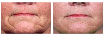 Restylane before and after photo