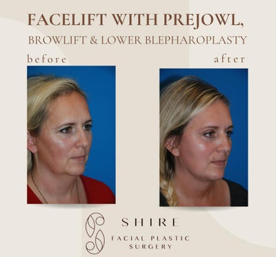 Facelift before and after photo
