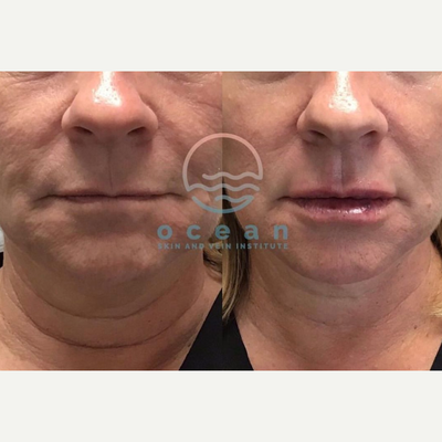 Lip Fillers before and after photo