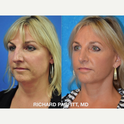 Eyelid Surgery before and after photo
