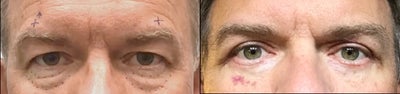 Eyelid Surgery before and after photo