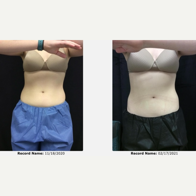 CoolSculpting before and after photo