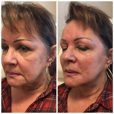 Liquid Facelift before and after photo