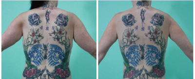 Arm Lift before and after photo