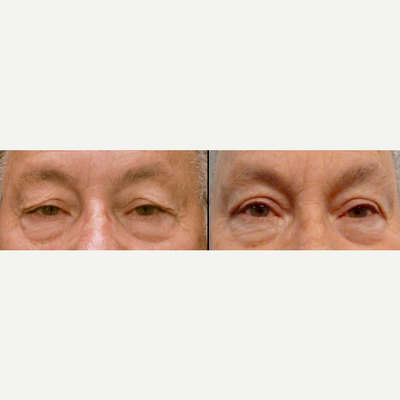 Eyelid Surgery before and after photo