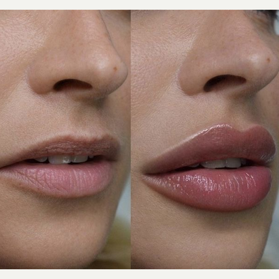 Lip Fillers before and after photo