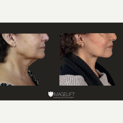 Dermal Fillers before and after photo