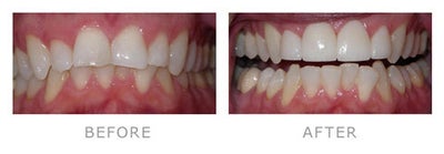 Porcelain Veneers before and after photo