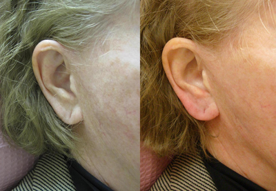 Restylane before and after photo