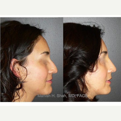 Nonsurgical Nose Job before and after photo