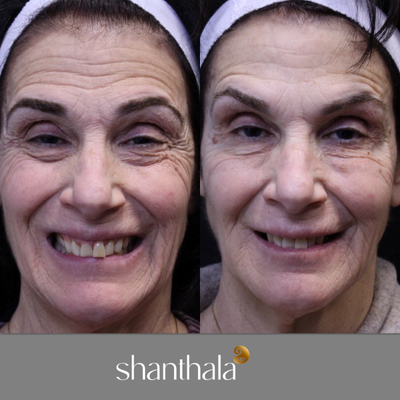 Cheek Fillers before and after photo