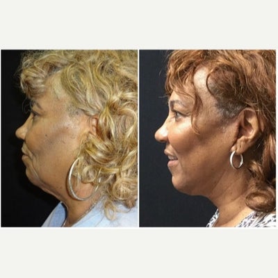 Facelift before and after photo