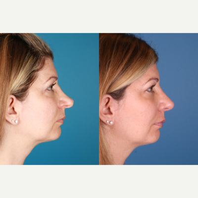 Revision Rhinoplasty before and after photo