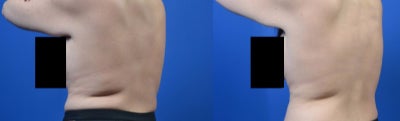 SculpSure before and after photo