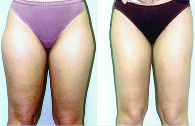Liposuction before and after photo