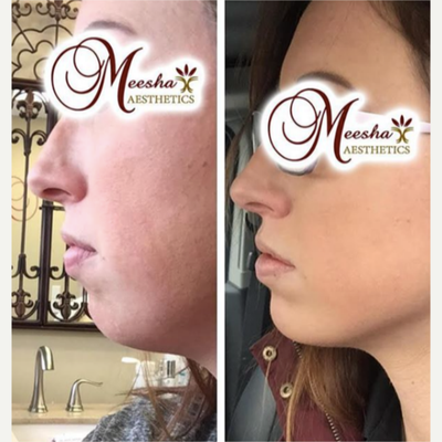 Kybella before and after photo