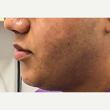 Accutane kosten