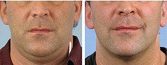 Thermage before and after photo