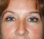 https://fi.realself.com/full/2/c/1/Eyelid-Surgery-after-87069.jpg