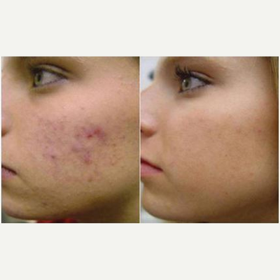 Laser Genesis before and after photo