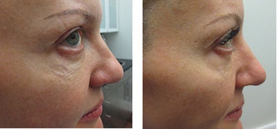 Ultherapy before and after photo