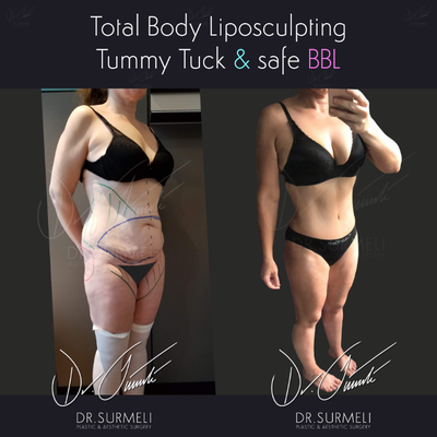 Liposuction before and after photo