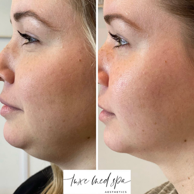 Kybella before and after photo