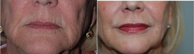 Juvederm before and after photo