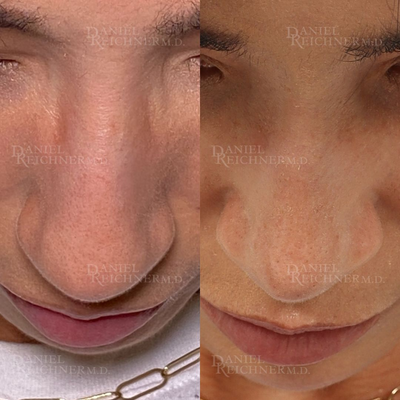 Rhinoplasty before and after photo