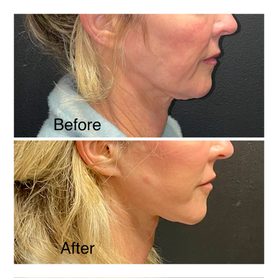 Facelift before and after photo