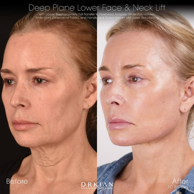 Neck Lift before and after photo