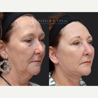 Revision Rhinoplasty before and after photo