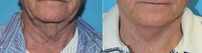 Neck Lift before and after photo