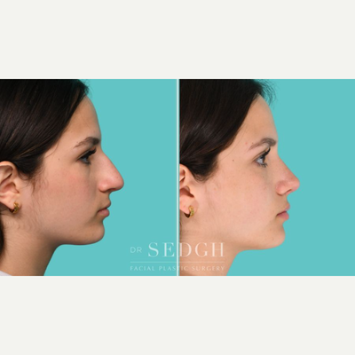 Rhinoplasty before and after photo