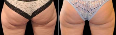 CoolSculpting before and after photo