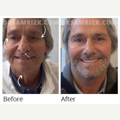 Deep Plane Facelift before and after photo