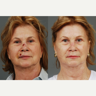 Mohs Surgery before and after photo