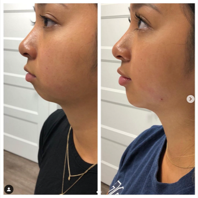 Chin Filler before and after photo
