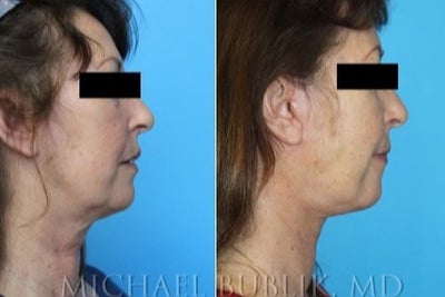 Facelift before and after photo