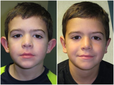 Ear Surgery before and after photo