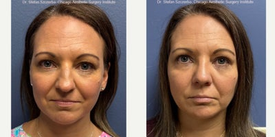 45-54 year old woman treated with Rhinoplasty, Septoplasty - 45-54 year old woman treated with Rhinoplasty, Septoplasty
